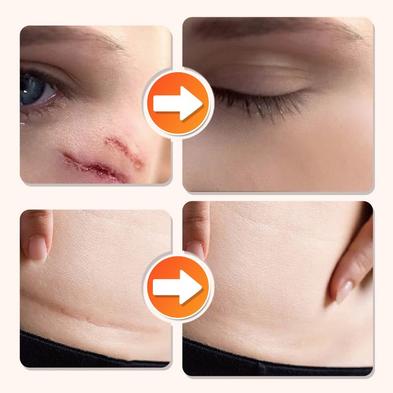 💦✨ Reusable waterproof silicone scar patch! Making scars invisible is not a dream ✨💦! - Image 2